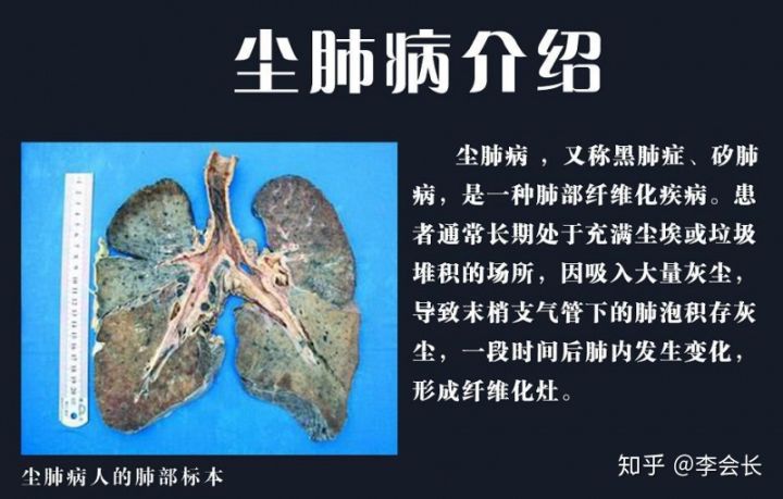 重疾險(xiǎn)