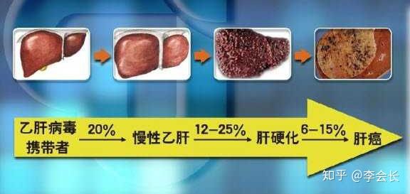 乙肝患者