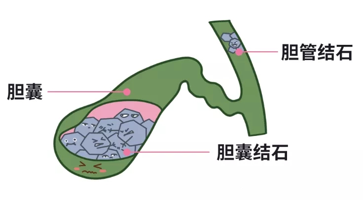 膽結(jié)石買(mǎi)保險(xiǎn)
