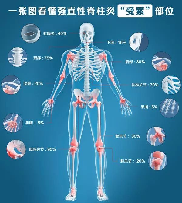 強(qiáng)直性脊柱炎可以買重疾險(xiǎn)嗎