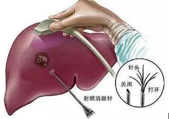 肺部結(jié)節(jié)可以買的重疾險(xiǎn)？投保重疾險(xiǎn)保額要考慮哪些因素？