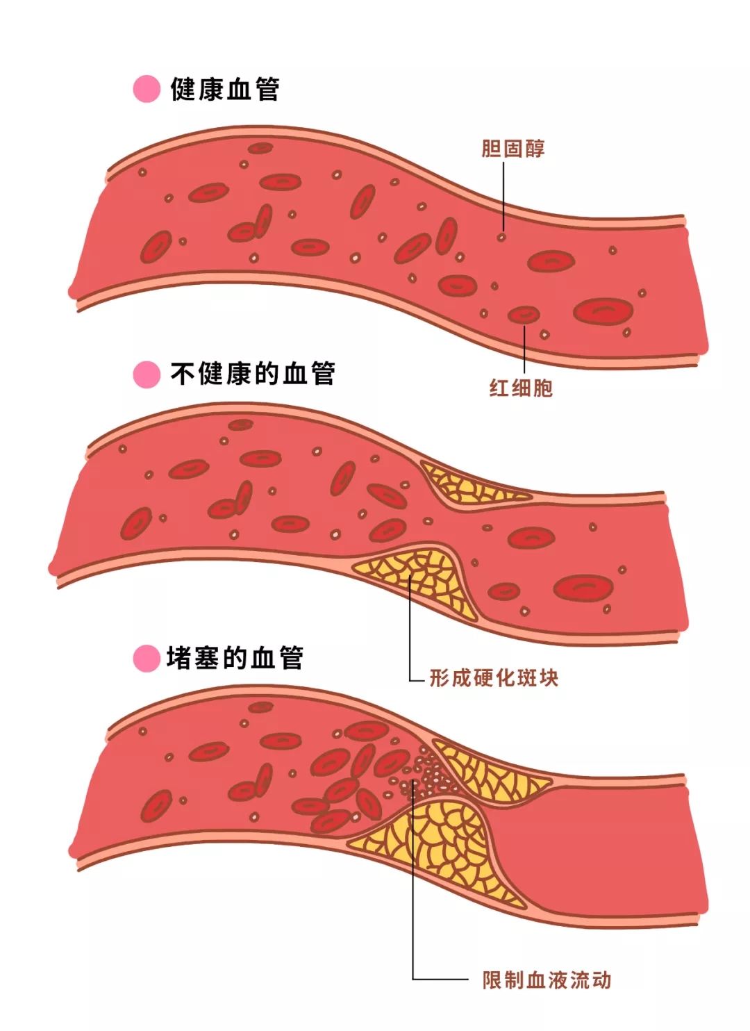 「 高血脂 」